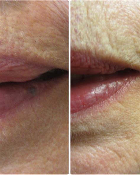 What is the blue spot on my lip? Venous lakes are a benign lesion