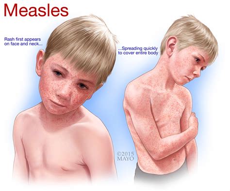 Expert Alert - Measles and Hearing Loss - Mayo Clinic News Network