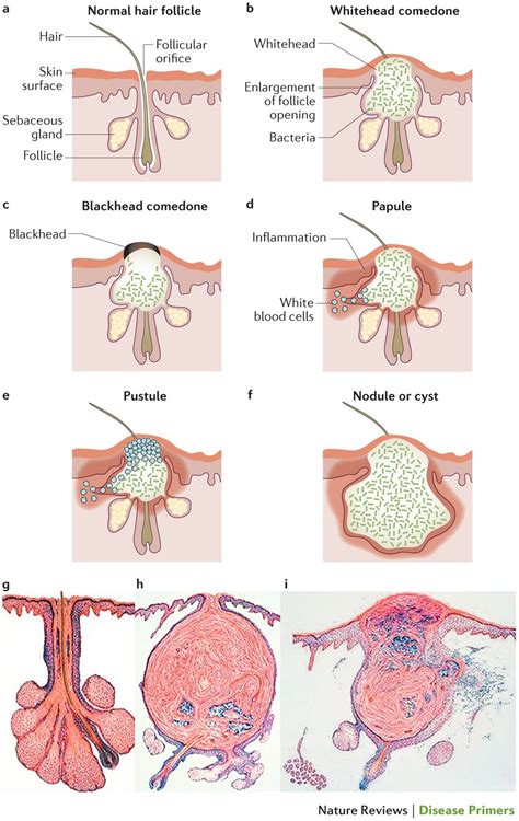 Blind Pimple Diagram - exatin.info