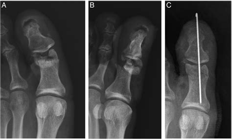 Osseous injuries of the foot: an imaging review. Part 1: the forefoot ...