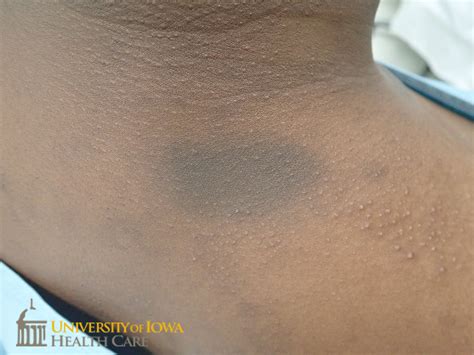 dark patches on skin face 6