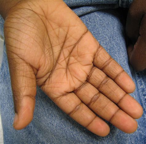 Diagnosis of Atopic Dermatitis