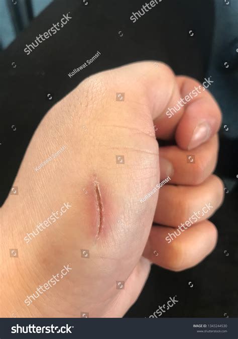 Laceration Wound Healing Stock Photo 1343244530 | Shutterstock