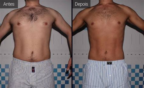 Gordura Nos Flancos Antes E Depois
