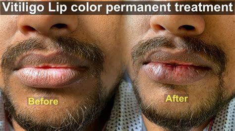 permanent lip color correction treatment  dark lips  white patch