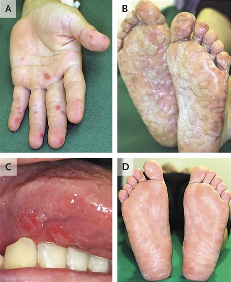 Hand foot and mouth disease, causes, signs, symptoms, diagnosis ...