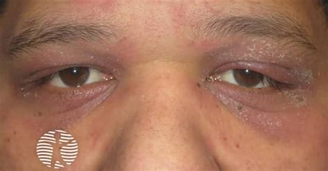 DermNet® - Dermatomyositis of eyelids image