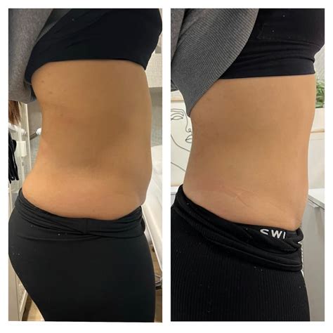 Fat Dissolving Injections London | London Beauty Clinic