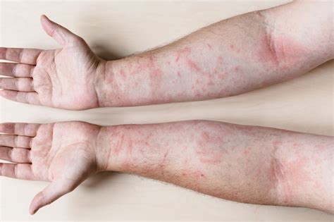 Allergic Contact Dermatitis - Aonang Medical Clinic