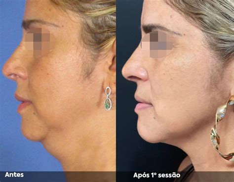 Hifu Antes E Depois