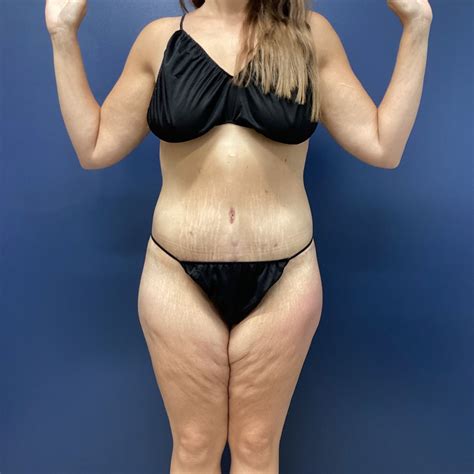 Sono bello skin removal cost shifts are helping patients 6