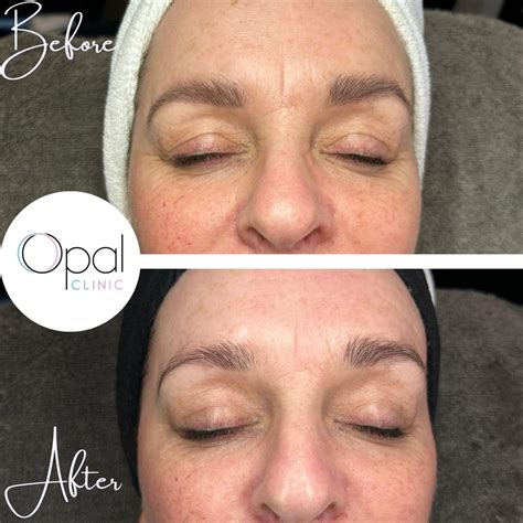 Before & After Gallery - Opal Clinic Falkirk - Professional Skincare ...