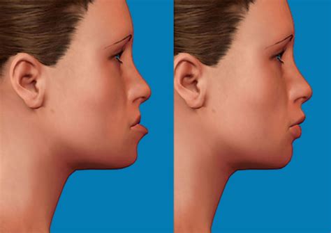 How to Fix Underbite Naturally Without Braces