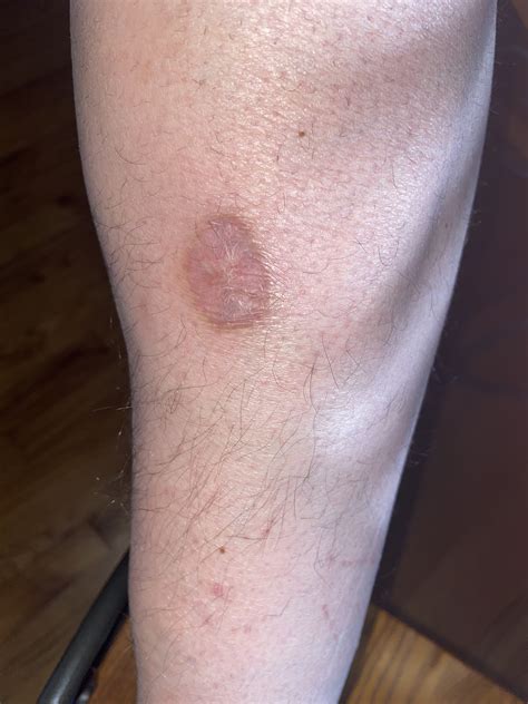 Michigan Brown Recluse spider bite or “suspected” bite (true story