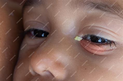 Bebê Com A Pálpebra Inchada