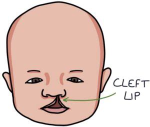 cleft lip   finals