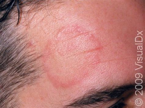 Ringworm Face