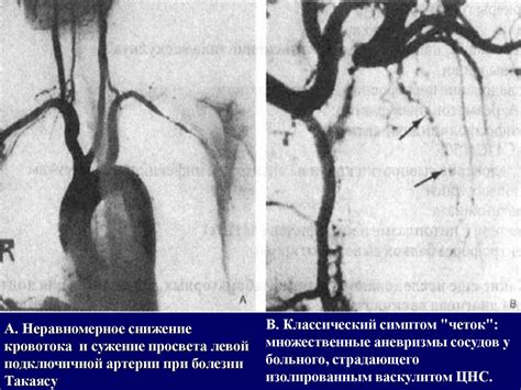 Неспецифический аортоартериит (болезнь Такаясу). Болезнь отсутствия ...