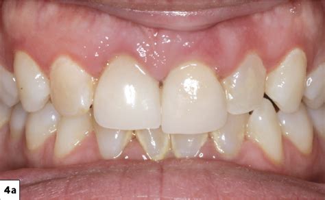 Socket Grafting & Immediate Implant Placement: Esthetic Zone