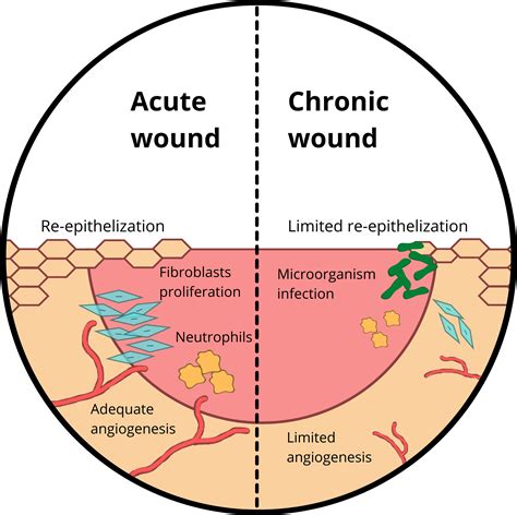 wound infection treatment types  russell chau blog