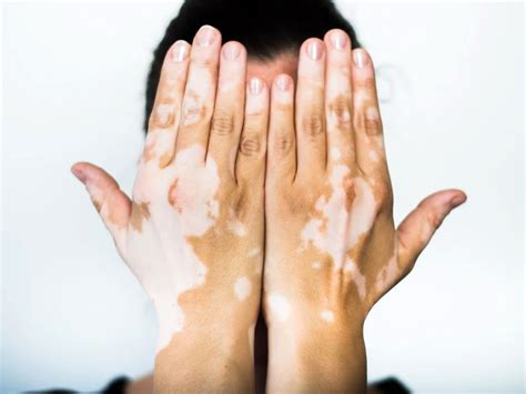 Vitiligo: Symptoms, Causes and Treatment