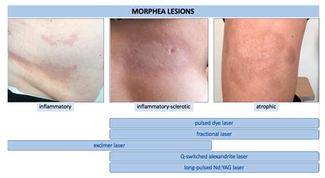 Generalized Morphea