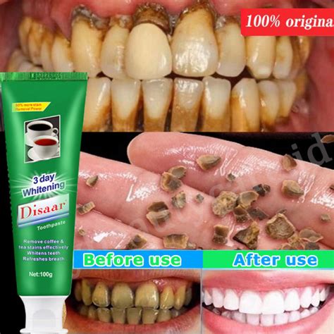 Teeth Whitening Toothpaste Remove tartar and clean yellow teeth toothpaste 100g Whitening ...