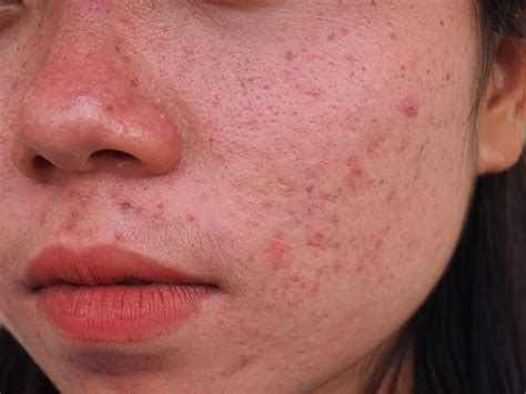 mengenal struktur kulit epidermis  fungsinya bagi tubuh eva mulia