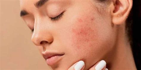 Have Acne Prone Skin? Here Are Some Things You Should Avoid Doing-Have ...