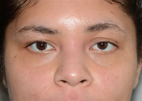 Double Eyelid #1182 - Amadi Aesthetics | Plastic Surgery & Med SPA