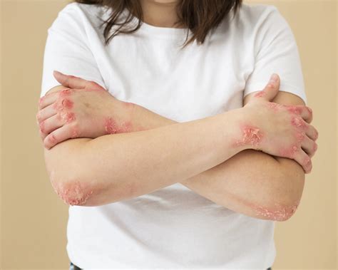 Hives | Sings Triggers Treatments | Optimists Wellness India