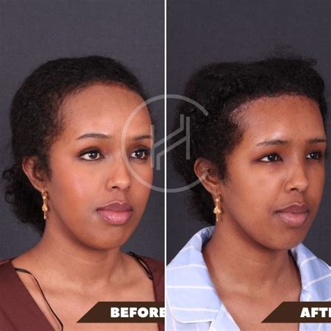 Forehead Reduction Before & After Photos - Unfiltered Results