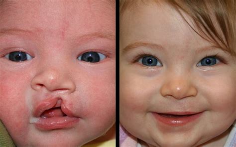 Cleft lip and palate - Santripty commonly isolated birth defects