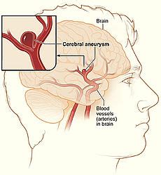 Cerebral Aneurysm - Causes, Symptoms, Treatment, Prognosis and Pictures