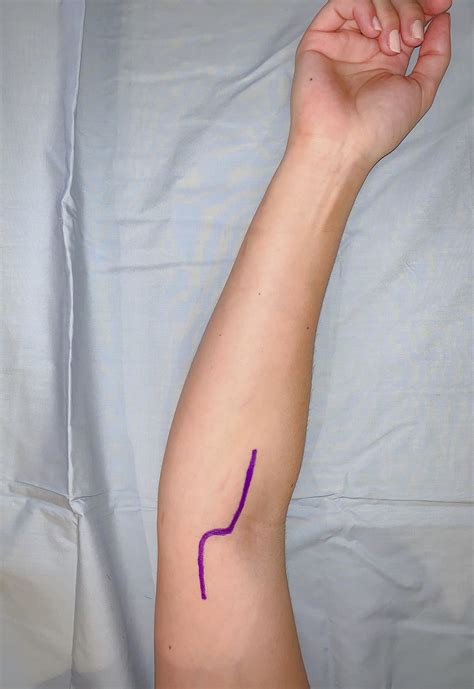 Proximal Median Nerve Compression: Pronator Syndrome - Journal of Hand ...