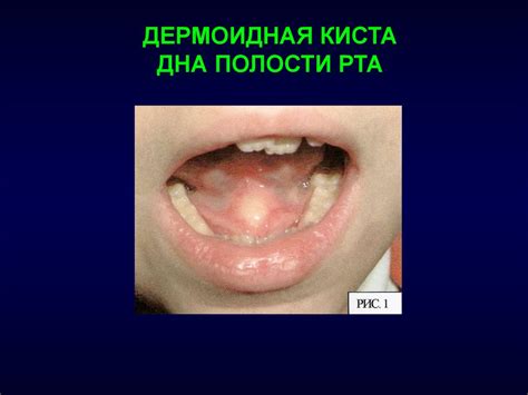 Врожденные синдромы. Врожденные кисты и свищи шеи. Дермоидные кисты ...