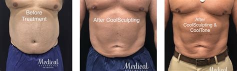 CoolSculpting | Norfolk, VA - Medical Aesthetics of Virginia