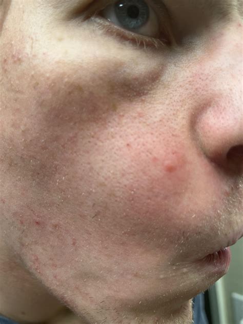 Dermatologists warn against deep blackhead removal at home 1