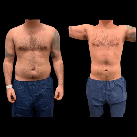 liposuction men