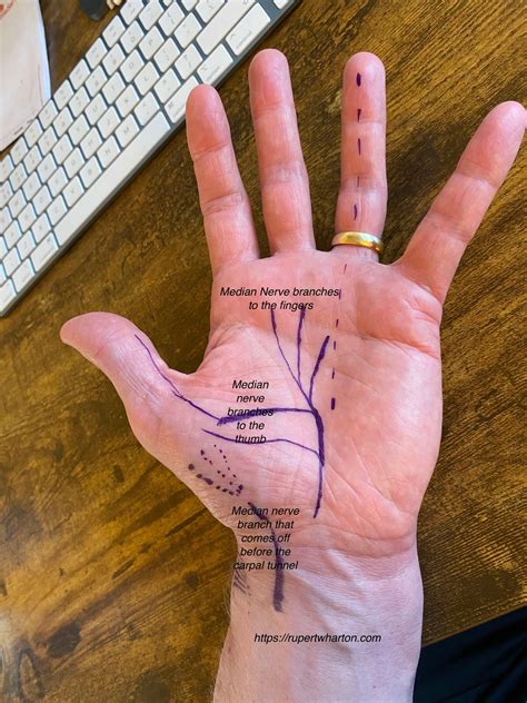 My carpal tunnel syndrome is bilateral, can I have both sides operated