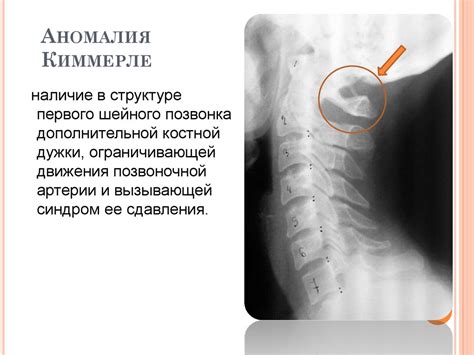 Аномалия Киммерле и ее хирургическая коррекция - презентация онлайн