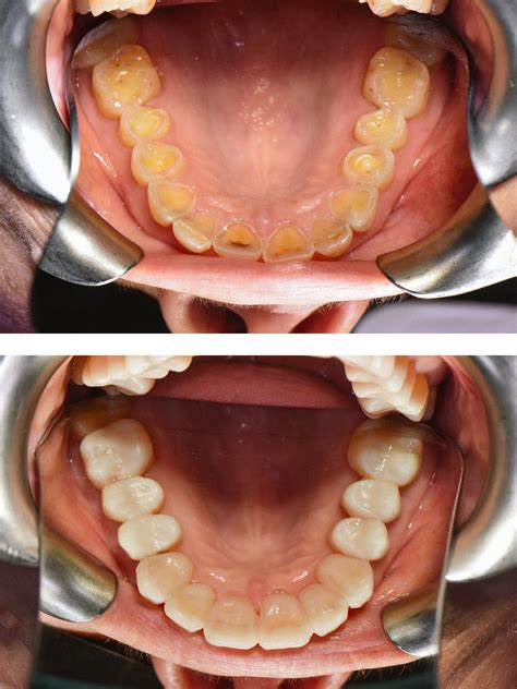 Occlusal Rehab — Maximilian Tu