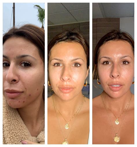 Face Breaking Out After Getting Off Birth Control at Robert Sandoval blog