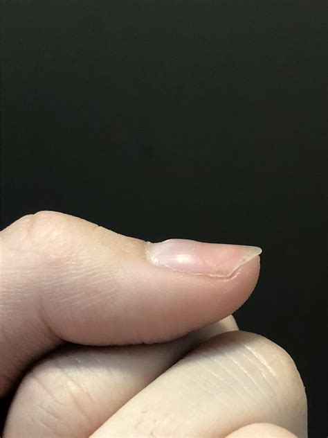 Raised Bumps On Fingernails