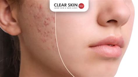 Naturally Eliminating Acne Scars: Expert Tips for Clearer Skin