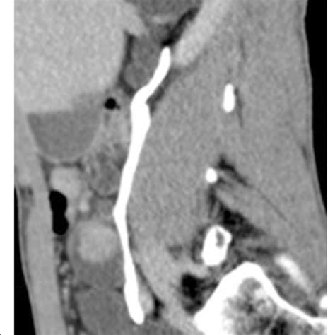 Uro-scan: right ureteral duplicity. The upper urinary system of the ...