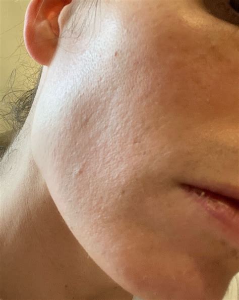 Does Electrodessication Cause Scarring at Howard Vasquez blog