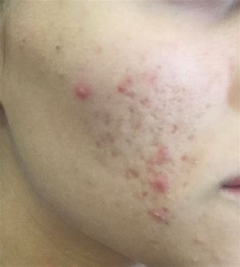 how to get rid of acne scarring