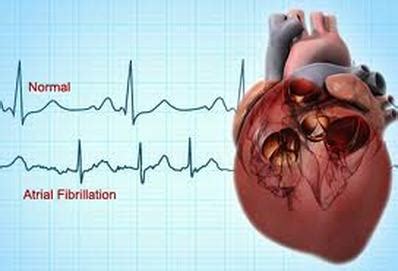 diagrams atrial fibrillation awareness