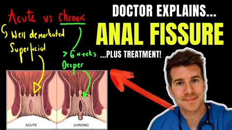 anal fissure   anal fissure sign  anal fissure  word